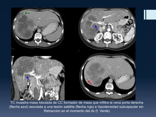 TC muestra masa lobulada de CC formador de masa que infiltra la vena porta derecha
(flecha azul) asociada a una lesión satélite (flecha roja) e hipodensidad subcapsular sin
Retracción en el momento del dx (f. Verde)

 