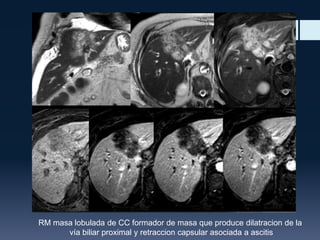 RM masa lobulada de CC formador de masa que produce dilatracion de la
vía biliar proximal y retraccion capsular asociada a ascitis

 