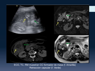 ECO, TC, RM muestran CC formador de masa (f. Amarilla)
Retraccion capsular (f. Verde)

 