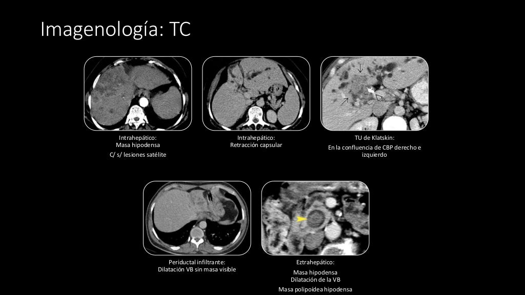 Colangiocarcinoma Colangiocarcinoma