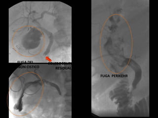 FUGA PERIKEHR
FUGA DEL
MUÑON CISTICO
COLEDOCOLITIASIS
RESIDUAL
 