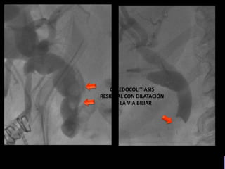COLEDOCOLITIASIS
RESIDUAL CON DILATACIÓN
DE LA VIA BILIAR
 