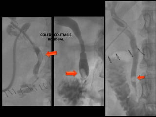 COLEDOCOLITIASIS
RESIDUAL
 