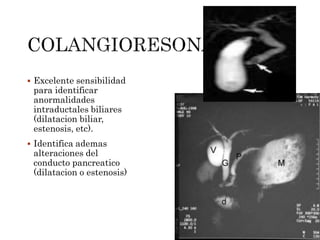  Excelente sensibilidad
para identificar
anormalidades
intraductales biliares
(dilatacion biliar,
estenosis, etc).
 Identifica ademas
alteraciones del
conducto pancreatico
(dilatacion o estenosis)
 
