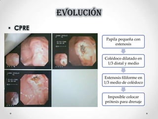 EVOLUCIÓN
• CPRE
Papila pequeña con
estenosis
Colédoco dilatado en
1/3 distal y medio
Estenosis filiforme en
1/3 medio de colédoco
Imposible colocar
prótesis para drenaje
 