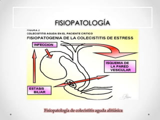 FISIOPATOLOGÍA
Fisiopatología de colecistitis aguda alitiásica
 
