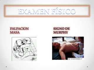 SIGNO DE
MURPHY
PALPACION
MASA
 