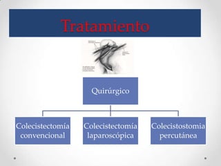 Tratamiento
Quirúrgico
Colecistectomía
convencional
Colecistectomía
laparoscópica
Colecistostomia
percutánea
 