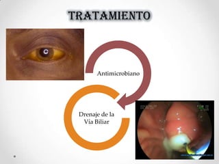TRATAMIENTO
Antimicrobiano
Drenaje de la
Vía Biliar
 