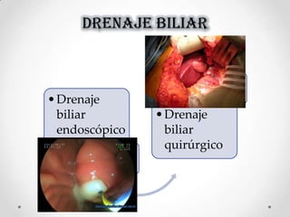 DRENAJE BILIAR
•Drenaje
biliar
endoscópico
•Drenaje
biliar
quirúrgico
 
