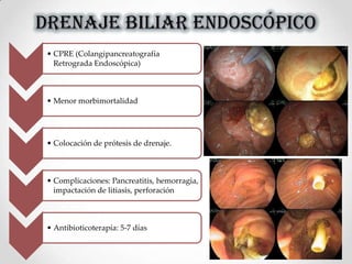 DRENAJE BILIAR ENDOSCÓPICO
• CPRE (Colangipancreatografía
Retrograda Endoscópica)
• Menor morbimortalidad
• Colocación de prótesis de drenaje.
• Complicaciones: Pancreatitis, hemorragia,
impactación de litiasis, perforación
• Antibioticoterapía: 5-7 días
 