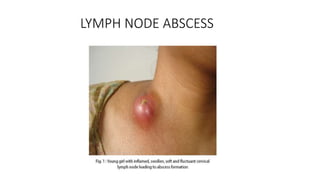LYMPH NODE ABSCESS
 