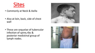 Sites
• Commonly at Neck & Axilla
• Also at loin, back, side of chest
wall
• These are sequelae of tubercular
infection of spine,ribs &
posterior medistinal group of
lymph nodes.
 