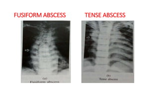 FUSIFORM ABSCESS TENSE ABSCESS
 