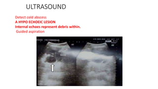 ULTRASOUND
Detect cold abscess
A HYPO ECHOEIC LESION
Internal echoes represent debris within.
Guided aspiration
 