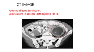 CT IMAGE
Patterns of bony destruction.
Calcifications in abscess (pathognomic for Tb)
 