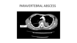 PARAVERTEBRAL ABSCESS
 