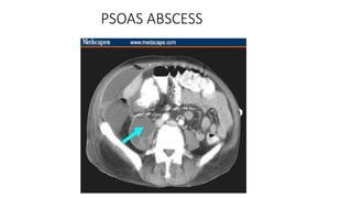 PSOAS ABSCESS
 