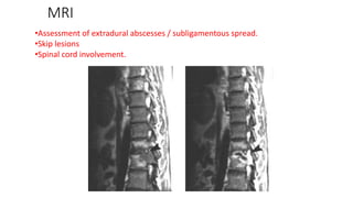 MRI
•Assessment of extradural abscesses / subligamentous spread.
•Skip lesions
•Spinal cord involvement.
 