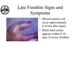 Late Frostbite Signs and
Symptoms
• Blisters/edema will
occur approximately
6-24 hrs after injury
• Black hard eschar
appears within 4-10
days if severe frostbite
 