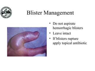 Blister Management
• Do not aspirate
hemorrhagic blisters
• Leave intact
• If blisters rupture
apply topical antibiotic
 