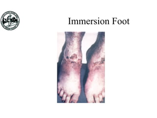 Immersion Foot
 