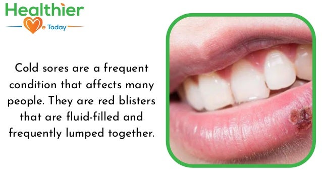 Cold Sores - Healthier Me Today | PDF