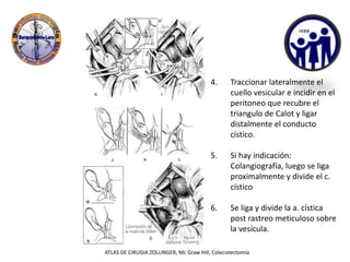 4. Traccionar lateralmente el
cuello vesicular e incidir en el
peritoneo que recubre el
triangulo de Calot y ligar
distalmente el conducto
cístico.
5. Si hay indicación:
Colangiografía, luego se liga
proximalmente y divide el c.
cístico
6. Se liga y divide la a. cística
post rastreo meticuloso sobre
la vesícula.
ATLAS DE CIRUGIA ZOLLINGER, Mc Graw Hill, Colecistectomía
 