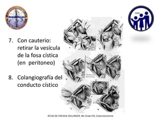 7. Con cauterio:
retirar la vesícula
de la fosa cística
(en peritoneo)
8. Colangiografía del
conducto cístico
ATLAS DE CIRUGIA ZOLLINGER, Mc Graw Hill, Colecistectomía
 