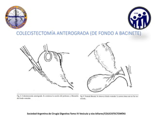 COLECISTECTOMÍA ANTEROGRADA (DE FONDO A BACINETE)
Sociedad Argentina de Cirugia Digestiva Tomo IV Vesícula y vías biliares/COLECISTECTOMÍAS
 