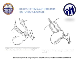 COLECISTECTOMÍA ANTEROGRADA
(DE FONDO A BACINETE)
Sociedad Argentina de Cirugia Digestiva Tomo IV Vesícula y vías biliares/COLECISTECTOMÍAS
 