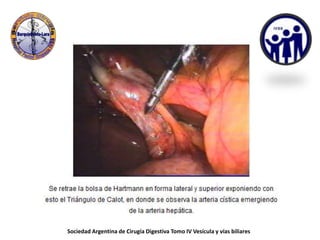 Sociedad Argentina de Cirugía Digestiva Tomo IV Vesícula y vías biliares
 