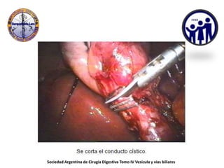 Sociedad Argentina de Cirugía Digestiva Tomo IV Vesícula y vías biliares
 