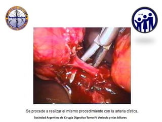 Sociedad Argentina de Cirugía Digestiva Tomo IV Vesícula y vías biliares
 