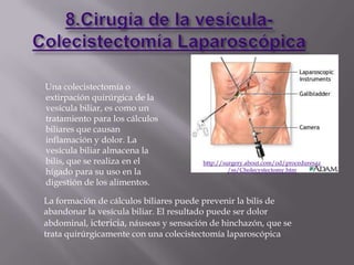 Una colecistectomía o
extirpación quirúrgica de la
vesícula biliar, es como un
tratamiento para los cálculos
biliares que causan
inflamación y dolor. La
vesícula biliar almacena la
bilis, que se realiza en el            http://surgery.about.com/od/proceduresaz
hígado para su uso en la                        /ss/Cholecystectomy.htm

digestión de los alimentos.

La formación de cálculos biliares puede prevenir la bilis de
abandonar la vesícula biliar. El resultado puede ser dolor
abdominal, ictericia, náuseas y sensación de hinchazón, que se
trata quirúrgicamente con una colecistectomía laparoscópica
 
