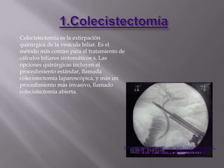 Colecistectomía es la extirpación
quirúrgica de la vesícula biliar. Es el
método más común para el tratamiento de
cálculos biliares sintomáticos s. Las
opciones quirúrgicas incluyen el
procedimiento estándar, llamada
colecistectomía laparoscópica, y más un
procedimiento más invasivo, llamado
colecistectomía abierta.




                                      http://www.righthealth.com/topic/Cholecystectomy_
                                            Diet?p=l&as=goog&ac=404&kgl=35736232
 