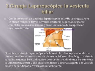    Con la invención de la técnica laparoscópica en 1989, la cirugía ahora
    se puede realizar a través de varias aberturas pequeñas, se puede
    completar en una a tres horas, y tiene un tiempo de recuperación
    mucho más corto.             http://www.pbennett.com.au/operations.html




Durante una cirugía laparoscópica de la vesícula, el tubo portador de una
cámara de video se inserta a través de una incisión en el ombligo. La cirugía
se realiza entonces bajo la dirección de esta cámara. diminutos instrumentos
se utilizan para cortar y clip en los conductos y arterias adjunto a la vesícula
biliar y para extirpar la vesícula biliar del cuerpo.
 