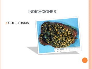 INDICACIONES
 COLELITIASIS
 