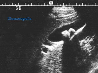 Ultrasonografía 
 