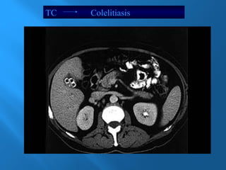TC Colelitiasis 
 