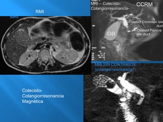 MMRRII –– CCoolleecciissttoo-- 
CCoollaannggiioorrrreessoonnaanncciiaa-- 
MMRRII SSIINN CCOONNTTRRAASSTTEE 
((ccoollaannggiioo--rreessoonnaanncciiaa)) 
MRI 
RMI 
Colecisto- 
Colangiorresonancia 
Magnética 
CCRM 
 