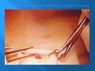 Levantamiento de pliegue umbiblical (Aguja de Verres) 
 