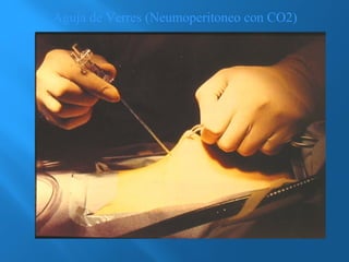 Aguja de Verres (Neumoperitoneo con CO2) 
 