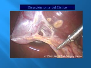 Disección roma del Cístico 
 