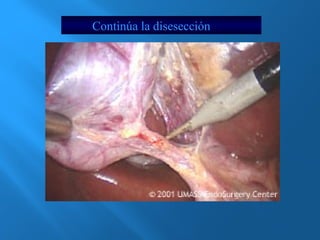 Continúa la disesección 
 