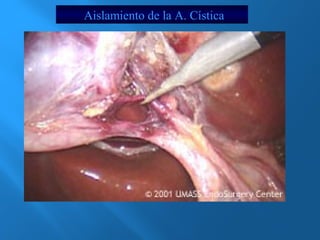 Aislamiento de la A. Cística 
 