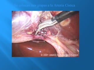 Se colocan tres grapas a la Arteria Cística 
 