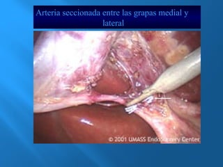 Arteria seccionada entre las grapas medial y 
lateral 
 