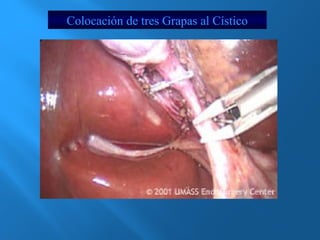 Colocación de tres Grapas al Cístico 
 