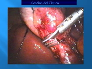 Sección del Cístico 
 